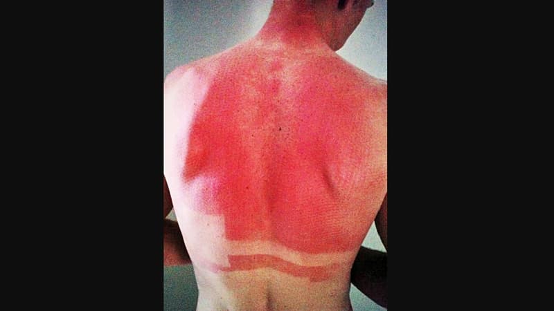 Christopher Froome victime d un violent coup de soleil en 2014 2111257